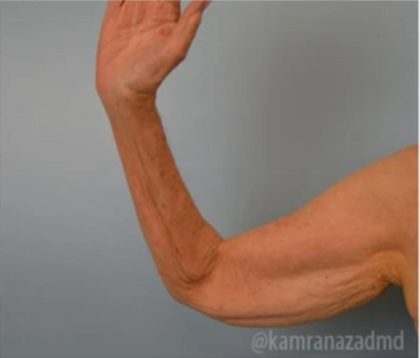 Arm Lift Before & After Patient #1498