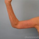 Arm Lift Before & After Patient #1498