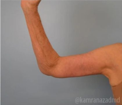 Arm Lift Before & After Patient #1498