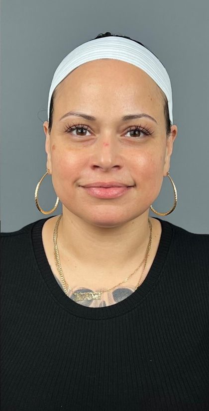 Botox & Fillers Before & After Patient #1532
