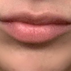 Botox & Fillers Before & After Patient #1533