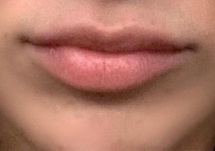Botox & Fillers Before & After Patient #1533