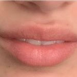 Botox & Fillers Before & After Patient #1533