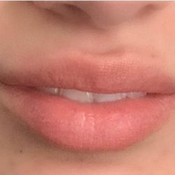 Botox & Fillers Before & After Patient #1533