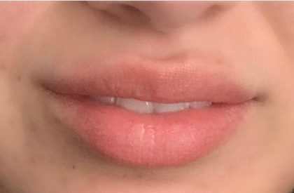 Botox & Fillers Before & After Patient #1533