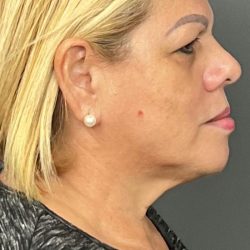 Botox & Fillers Before & After Patient #1537