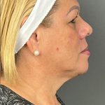 Botox & Fillers Before & After Patient #1537