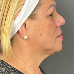 Botox & Fillers Before & After Patient #1537