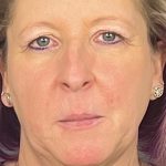 Botox & Fillers Before & After Patient #1538