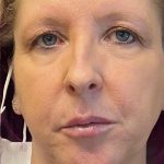 Botox & Fillers Before & After Patient #1538