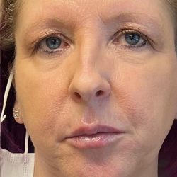 Botox & Fillers Before & After Patient #1538