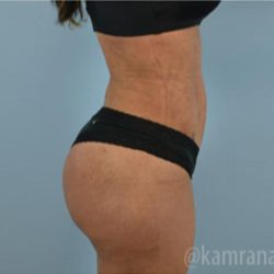 Brazilian Butt Lift Before & After Patient #1647