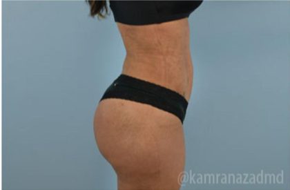 Brazilian Butt Lift Before & After Patient #1647