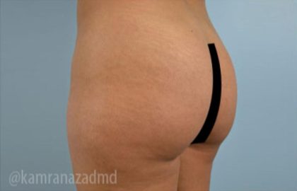 Brazilian Butt Lift Before & After Patient #1647