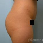Brazilian Butt Lift Before & After Patient #1648