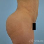 Brazilian Butt Lift Before & After Patient #1648