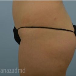 Brazilian Butt Lift Before & After Patient #1650