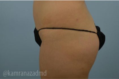 Brazilian Butt Lift Before & After Patient #1650