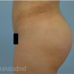 Brazilian Butt Lift Before & After Patient #1650
