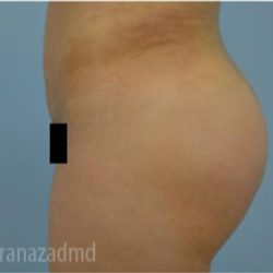 Brazilian Butt Lift Before & After Patient #1650