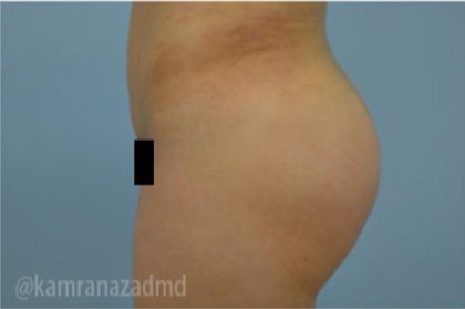 Brazilian Butt Lift Before & After Patient #1650
