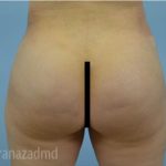 Brazilian Butt Lift Before & After Patient #1650