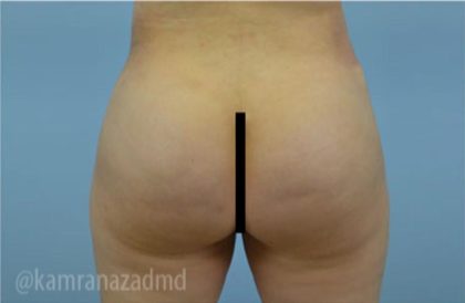 Brazilian Butt Lift Before & After Patient #1650