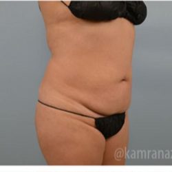 Brazilian Butt Lift Before & After Patient #1651