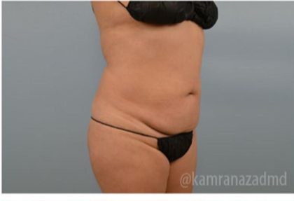 Brazilian Butt Lift Before & After Patient #1651
