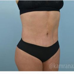Brazilian Butt Lift Before & After Patient #1651