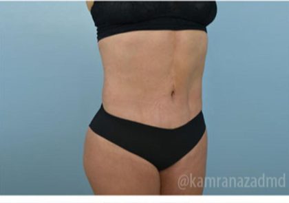 Brazilian Butt Lift Before & After Patient #1651