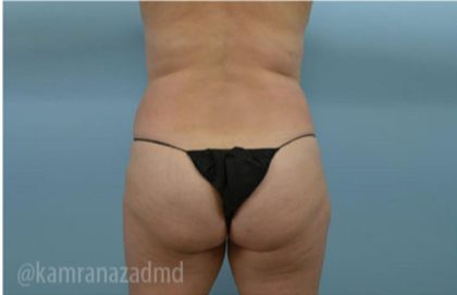 Brazilian Butt Lift Before & After Patient #1651