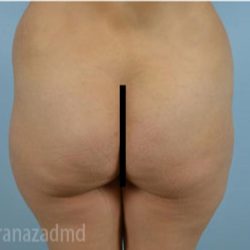 Brazilian Butt Lift Before & After Patient #1653