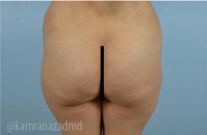 Brazilian Butt Lift Before & After Patient #1653