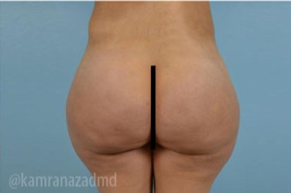 Brazilian Butt Lift Before & After Patient #1653