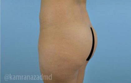 Brazilian Butt Lift Before & After Patient #1653