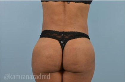 Brazilian Butt Lift Before & After Patient #1655