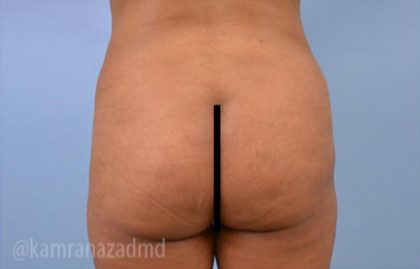 Brazilian Butt Lift Before & After Patient #1655