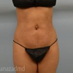 Brazilian Butt Lift Before & After Patient #1656
