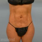Brazilian Butt Lift Before & After Patient #1656