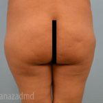 Brazilian Butt Lift Before & After Patient #1658