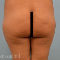 Brazilian Butt Lift Before & After Patient #1658