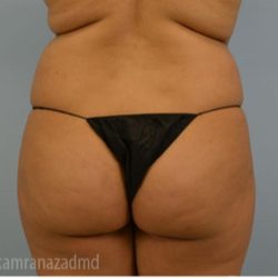 Brazilian Butt Lift Before & After Patient #1661