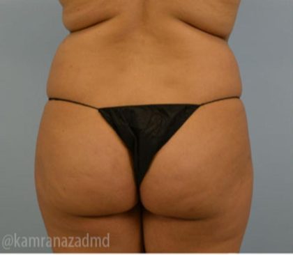 Brazilian Butt Lift Before & After Patient #1661