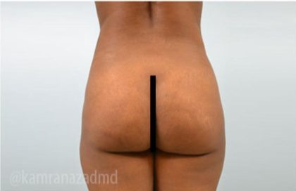 Brazilian Butt Lift Before & After Patient #1632