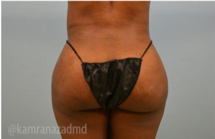 Brazilian Butt Lift Before & After Patient #1632