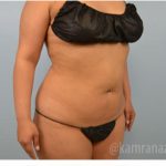 Brazilian Butt Lift Before & After Patient #1663