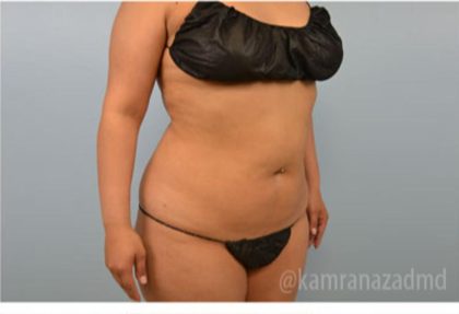 Brazilian Butt Lift Before & After Patient #1663