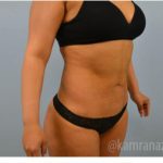 Brazilian Butt Lift Before & After Patient #1663