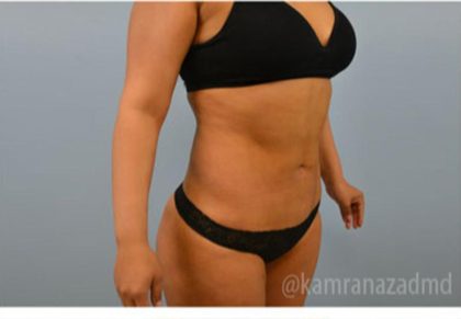 Brazilian Butt Lift Before & After Patient #1663